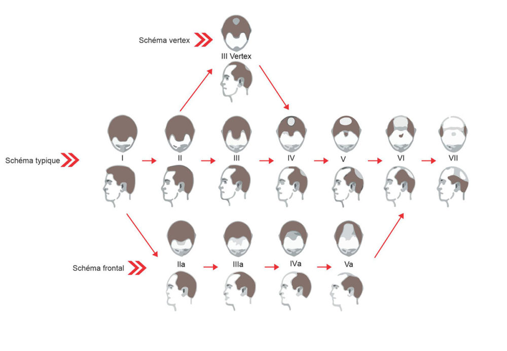 evaluation stade alopecie et evolution calvitie