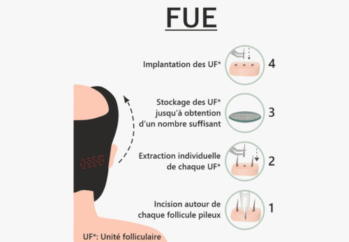 greffe capillaire fue comment ca marche explication et etape