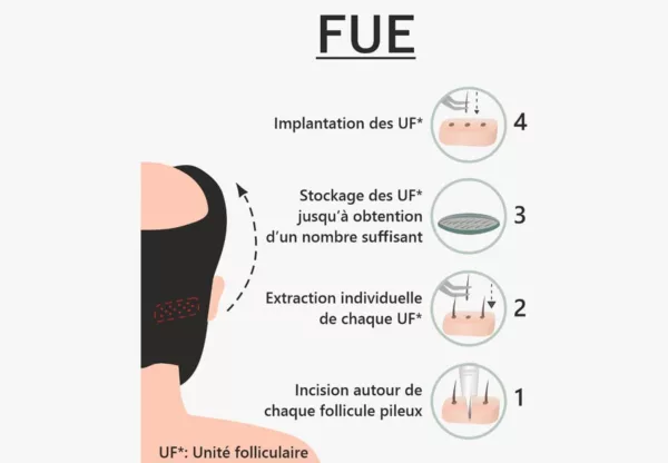 greffe capillaire fue comment ca marche explication et etape