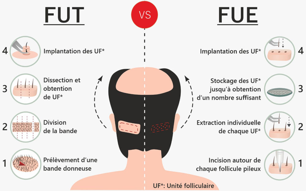 fut ou fue greffe de cheveux methode et explication difference