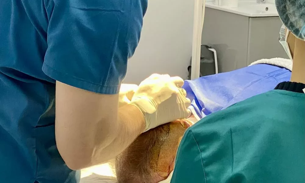 greffe de cheveux fue